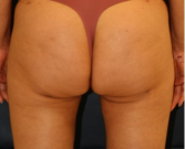 Feel Beautiful - Liposuction Inner Thighs 204 - After Photo